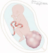 Những thông tin cần biết về u quái cùng cụt