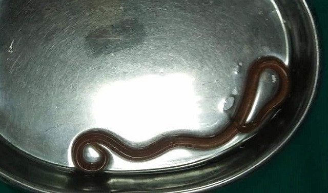 Kinh hoàng giun đũa dài 15 cm ký sinh trong dạ dày