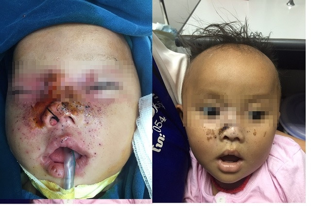 Bé trai 9 tháng tuổi bị súng kíp cướp cò bắn thẳng vào mặt