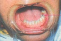 Trị sâu răng ở trẻ nhỏ