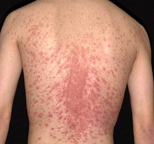 Suy thận vì tự ý điều trị thuốc lá chữa bệnh vẩy nến