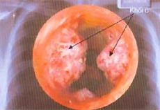 Hút thuốc lá gây bệnh hô hấp.