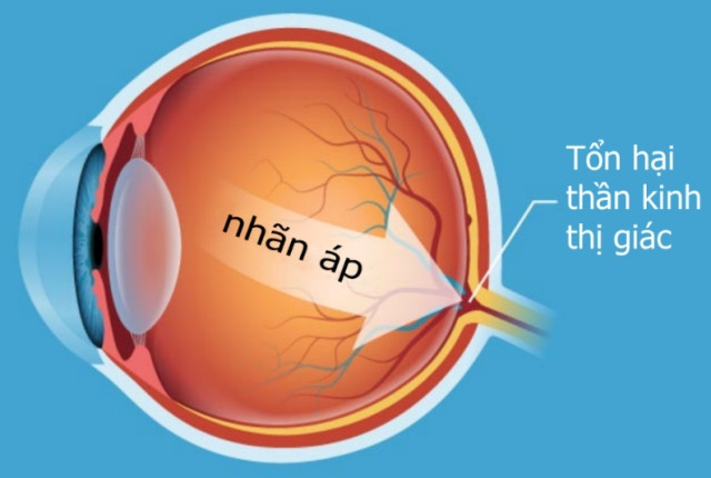 Bệnh glocom ở trẻ em liệu có nguy hiểm?