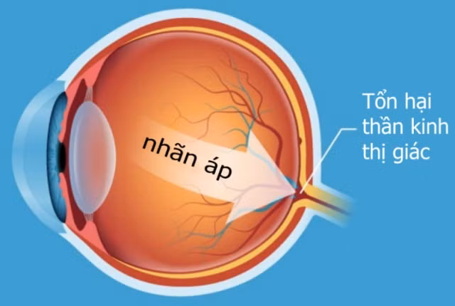 Bệnh glocom ở trẻ em liệu có nguy hiểm?