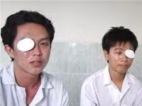 Bệnh nhân Nguyễn Thanh Tuấn
và Nguyễn Thanh Quang bị mù lòa
do tự ý nhỏ thuốc có chứa
corticoide, đã được phẫu thuật
tại