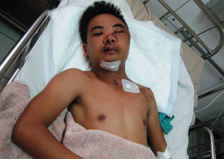 Sức khỏe của bệnh nhân Phan Hồng V. hiện đã dần ổn định.