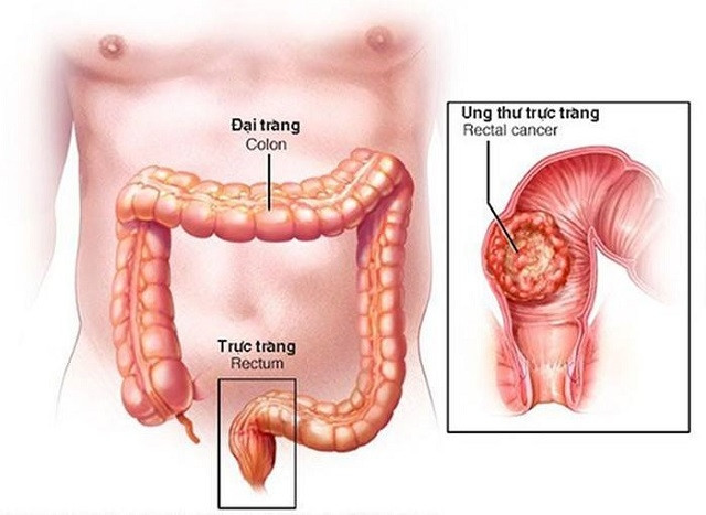 Phát hiện sớm ung thư đại tràng, tỷ lệ điều trị thành công cao 