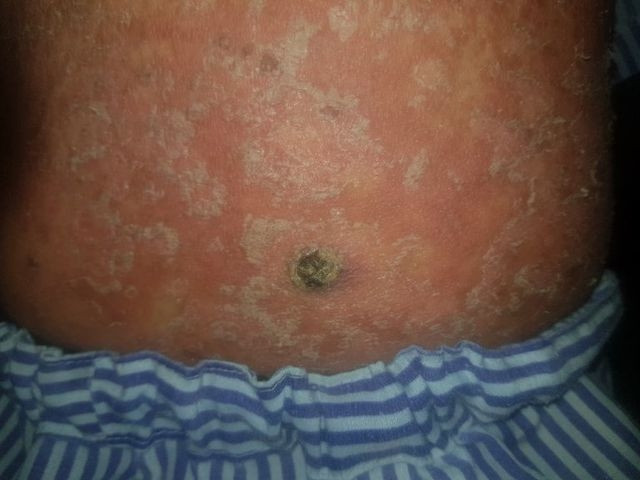 Tổn thương của bệnh nhân. 