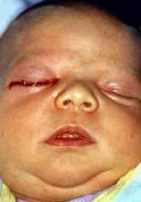 Viêm mũi ở trẻ sơ sinh: Không thể xem thường