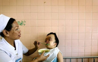 Cao Thị Lan Phương, 9 tuổi, bị chứng biến<br>dạng ở đầu đang được các bác sĩ<br>chăm sóc tại Làng Hòa Bình,<br>Bệnh viện