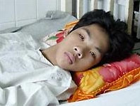 Bệnh nhân Võ Văn Tiến Dũng
mắc bệnh viêm cột sống dính khớp khi 18 tuổi.