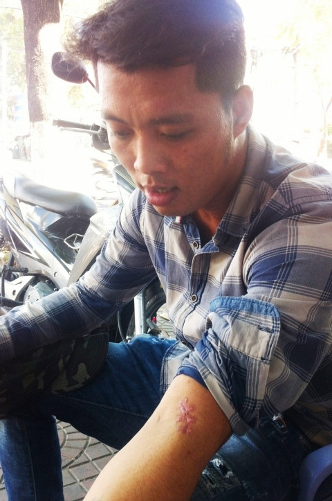Nguyễn Minh Nhật với vết thương bị chém vừa lành trên cánh tay.