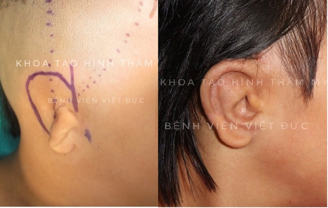 Khung tai nhân tạo mang lại vẻ đẹp thẩm mỹ cho các em.