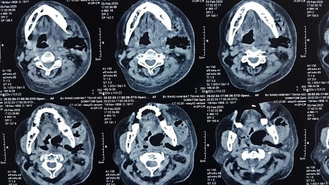 Khối mủ lớn vùng cổ dưới hàm bên T lan rộng.