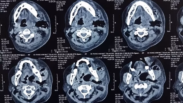 Khối mủ lớn vùng cổ dưới hàm bên T lan rộng.