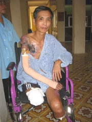 Bệnh nhân H bị bỏng điện cao thế
phải cắt cụt cả hai chân.