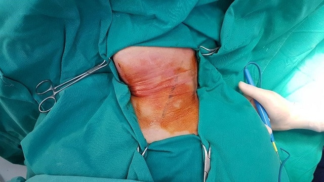 Khối áp xe tại cổ bệnh nhân. 