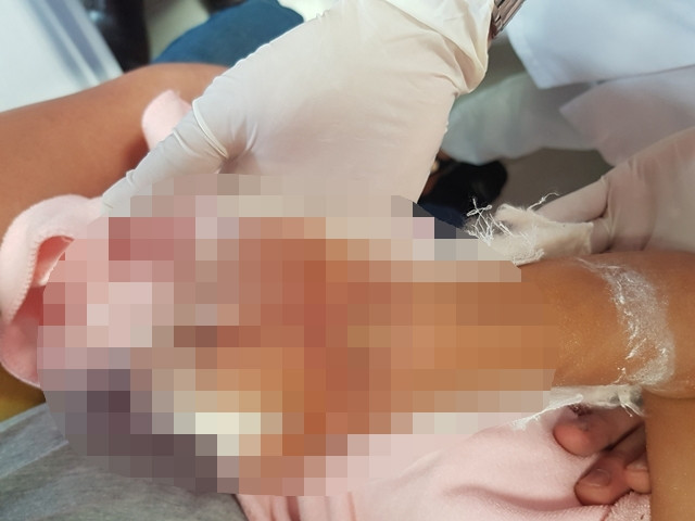 Cân não trước bàn tay phải gần đứt rời của bệnh nhi ba tuổi