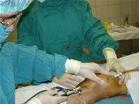 Điều trị một ca hoại tử đầu xương vô khuẩn phát hiện sớm nhờ phương pháp cộng hưởng từ