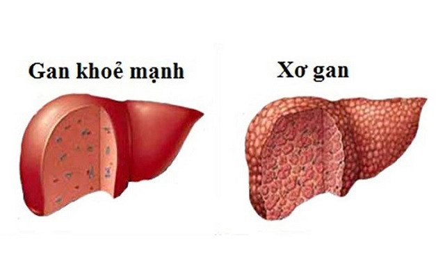 Hình ảnh xơ gan. (Hình minh họa).