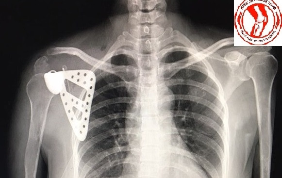 Bệnh nhân được thay xương bả vai.