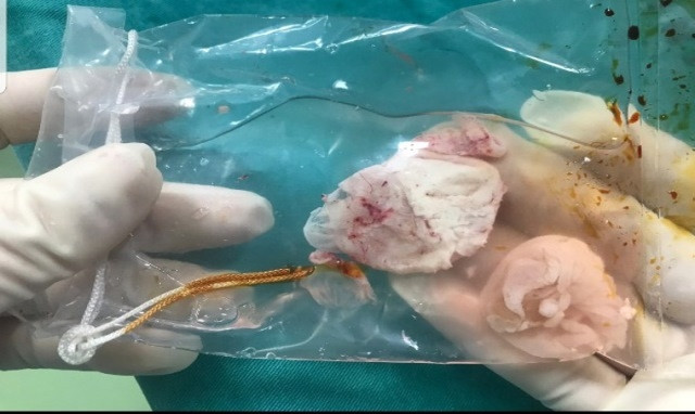 Hình ảnh kén sán được lấy ra trong não bệnh nhân. (Ảnh: BVCC)