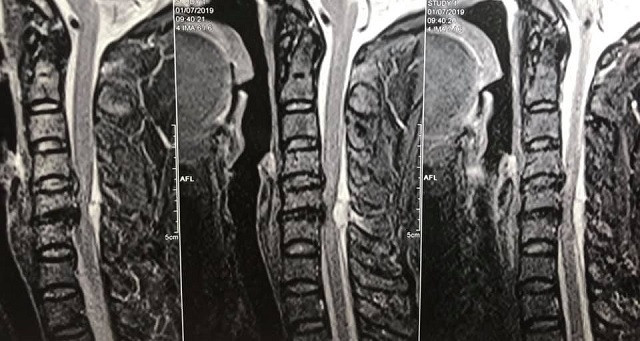 Hình ảnh khối máu tụ rất to chèn ép ống tủy cổ trên phim chụp cộng hưởng từ, nguyên nhân gây liệt cho bệnh nhân.