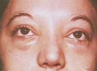 Biểu hiện phù mắt
do nhiễm giun xoắn.