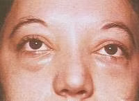 Biểu hiện phù mắt
do nhiễm giun xoắn.