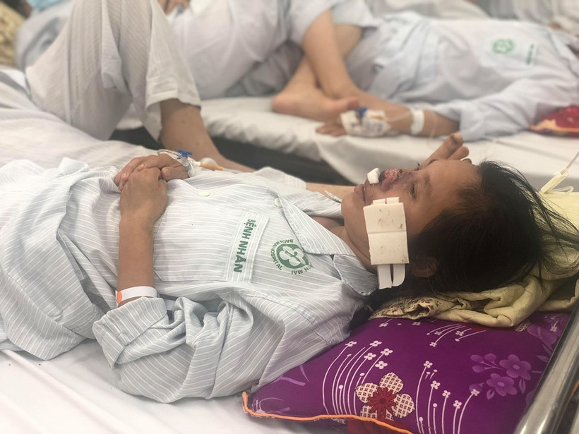 Một bệnh nhân bị vi khuẩn whitmore tấn công cánh mũi. 