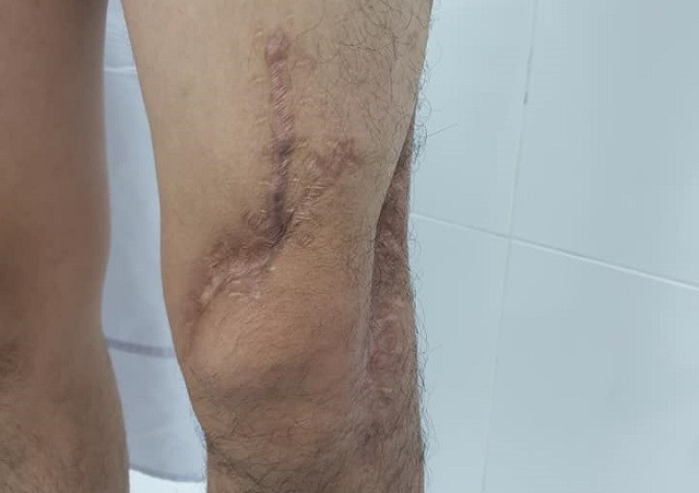 Chân trái của bệnh nhân đã hồi phục hoàn toàn.