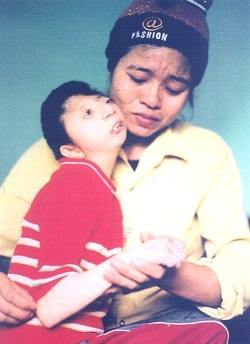 Nạn nhân của chất độc
da cam/dioxin