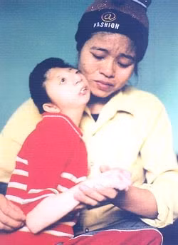 Nạn nhân của chất độc
da cam/dioxin