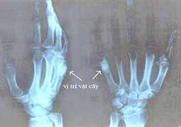 Thay xương bàn tay
bằng xương nhân tạo.