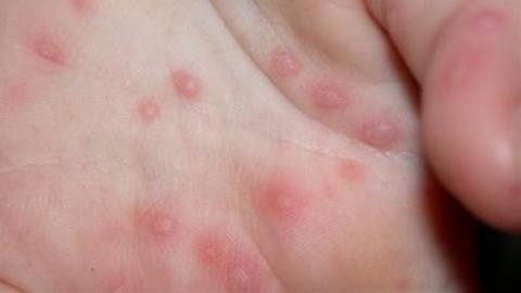 Bộ Y tế triển khai các giải pháp phòng chống bệnh tay chân miệng 