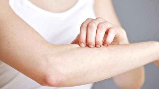 Người bị phản ứng phụ của thuốc ở mức độ nặng có thể gây phát ban ngứa, khó thở, tức ngực, sưng mặt…