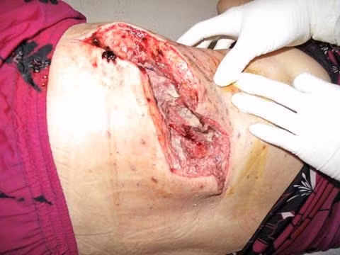 Nguy kịch tính mạng vì cắt lể bằng lưỡi lam