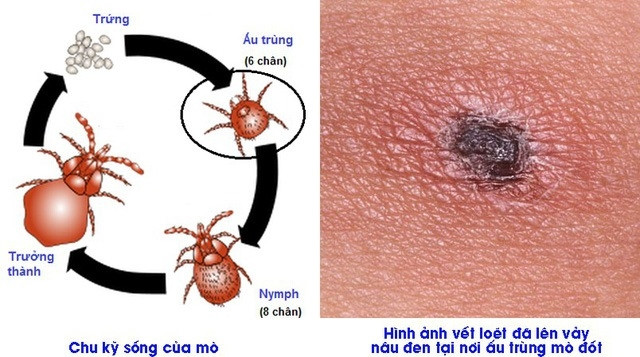 Sốt mò: căn bệnh ít biết nhưng nguy cơ tử vong cao