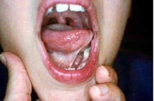 Dính thắng lưỡi ở trẻ nhỏ