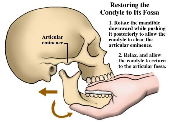 Minh họa cách nắn trật khớp thái dương hàm.