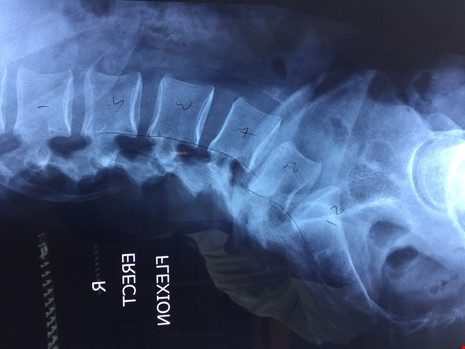 Hình ảnh chụp X-quang của bệnh nhân.