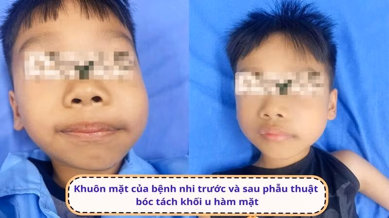 Khuôn mặt của bệnh nhi H trước và sau phẫu thuật bóc tách khối u hàm mặt.
