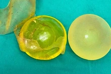 Túi ngực sau phẫu thuật tháo bỏ. 