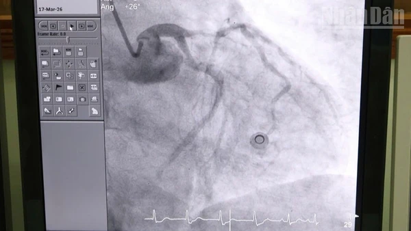 Sau khi can thiệp, tình trạng tim mạch của bệnh nhân dần ổn định, các chỉ số cải thiện rõ rệt. (Ảnh do đơn vị cung cấp)