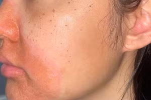 Một trường hợp viêm da sau thực hiện các thủ thuật làm đẹp tại spa.