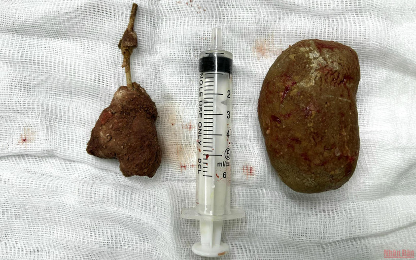 2 viên sỏi to với trọng lượng 300 g được phẫu thuật từ cơ thể bệnh nhân.