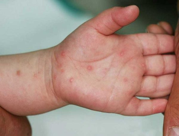 Không thiếu thuốc điều trị bệnh tay chân miệng
