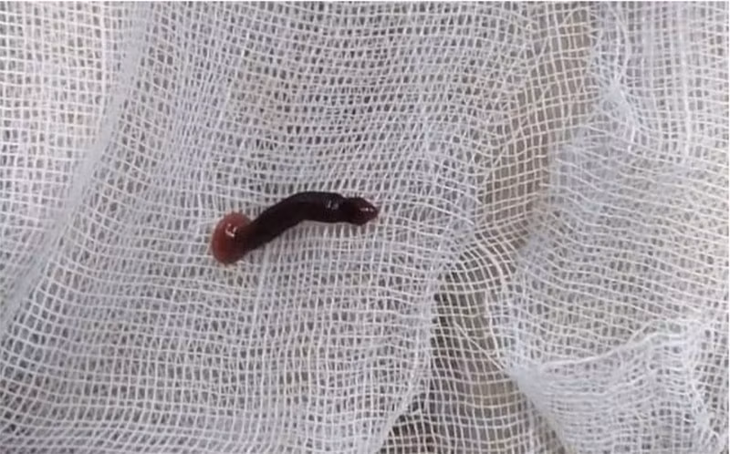 Con đỉa được gắp ra từ mũi em P.