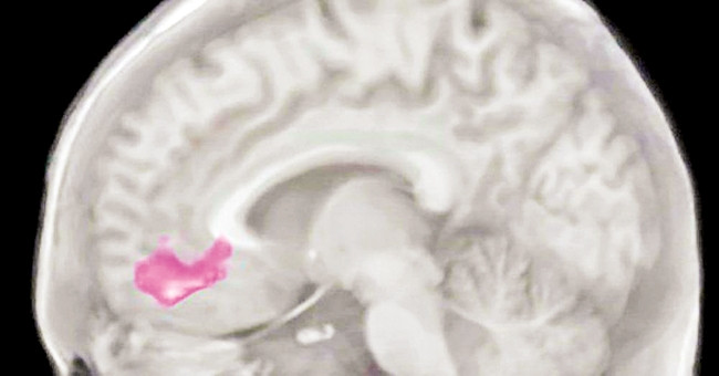 Vệt hồng là vùng vỏ não VMPC.