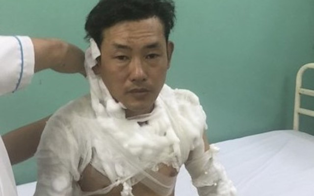 Lê Tấn Tài được can thiệp y tế khi bị bỏng.